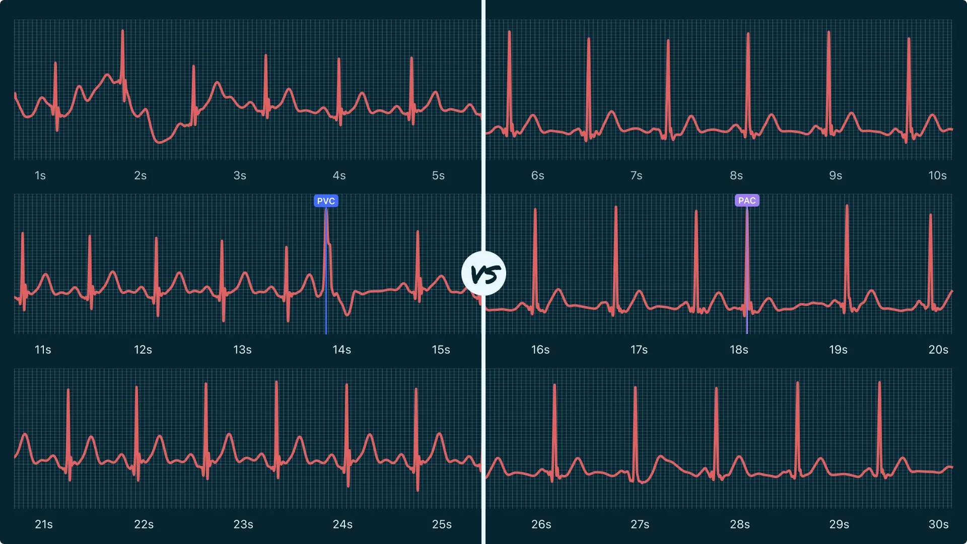 Premature Ventricular Contraction (PVC) Vs. Premature Atrial